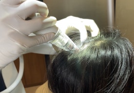 Hair Loss Care: Can It Help a Sensitive Scalp? image 7