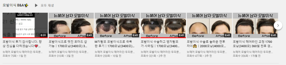 정수리모발이식 효과 알아봅시다 관련 이미지 14