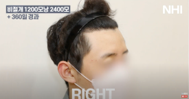 비절개 모발이식 헤어라인 엠자채우기 l 남자 탈모 모발이식 2400모 전후 사진 후기 관련 이미지 4