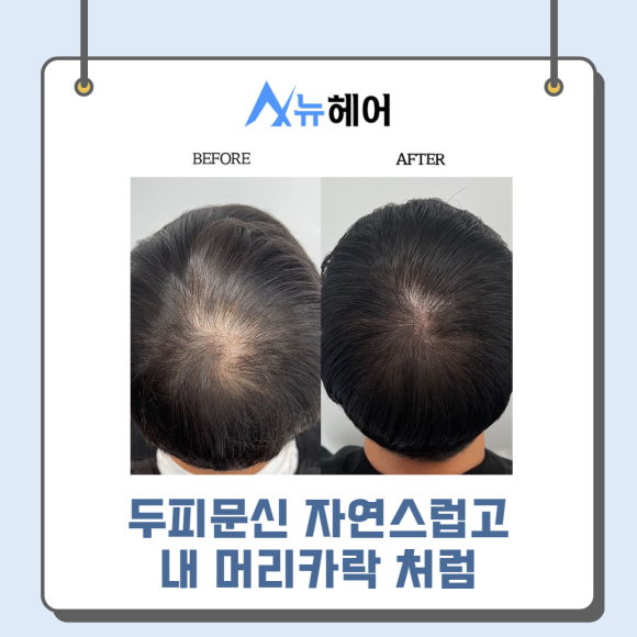 두피문신가격과 따져봐야 할 것은? 관련 이미지 6