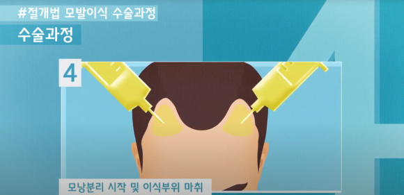 모발이식 수술 뉴헤어에서 알아보기(절개,비절개,헤어라인,모발이식방법,수술) 관련 이미지 5