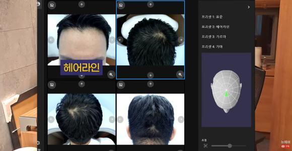 탈모검사? 저희의 AI / 3D 검사를 소개합니다 관련 이미지 9