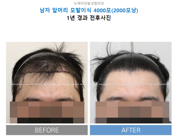 모발이식 후 탈모약, 먹는다? 안먹는다? 탈모의사가 알려드립니다 관련 이미지 5