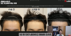 모발이식경과 1년을 기다려야 하는 이유 관련 이미지 9