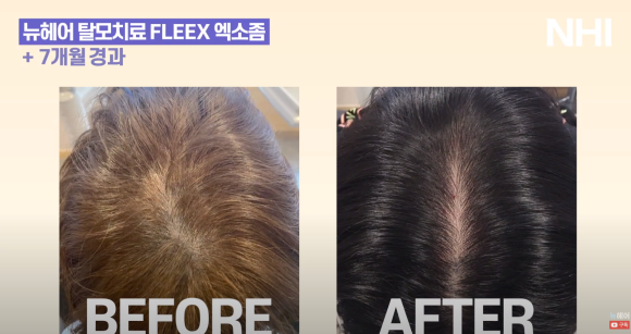 뉴헤어 탈모치료 모낭주사 7개월 전후 사진 관련 이미지 1