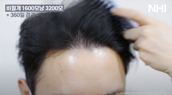 모발이식 비절개 1년 후기 전후사진 1600모낭 관련 이미지 6