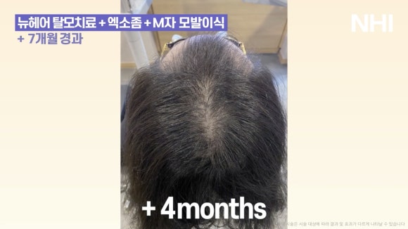 정수리탈모 엑소좀관리 7개월 경과 전후사진 관련 이미지 4