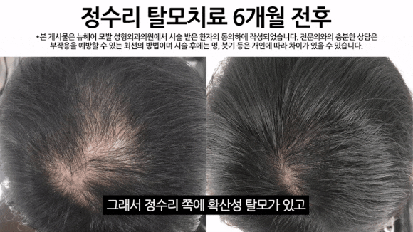 탈모치료방법, 비수술로 해결될까요? 관련 이미지 8