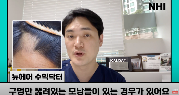 [뉴헤어] 모발이식으로도 해결 안 되는 탈모가 있다? l 탈모 주사의 효과는? 관련 이미지 21