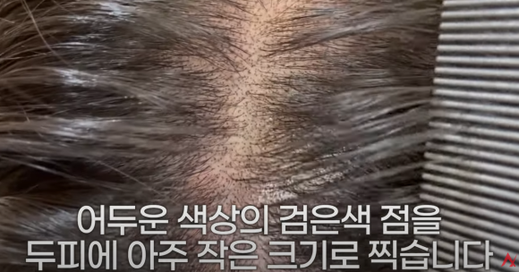 MZ세대 탈모 관리, 셀프 메디케이션? 가성비 치료방법? 관련 이미지 4