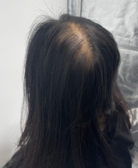 모발문신후기? 탈모치료와 병행한 40대 여성 환자분 사례 관련 이미지 4
