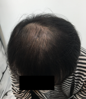 탈모치료주사? 효과 있을까 궁금하신 분들만 보세요 관련 이미지 8