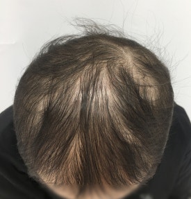 항암 탈모치료, 모발 회복에 도움이 되는 치료법은? 관련 이미지 2