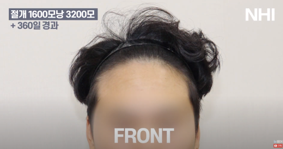 남자 모발이식 1600모낭 1년 지난 후 사진 경과 후기 관련 이미지 2