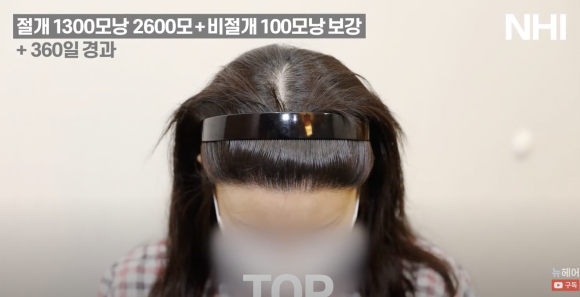 여자 모발이식 재수술 헤어라인교정 l  1300모낭 1년 경과 사진 l 3차 재수술 관련 이미지 7