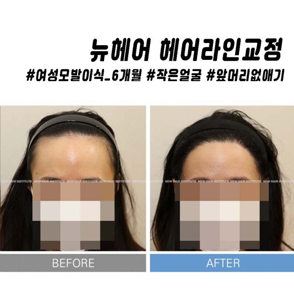 여성 헤어라인 모발이식 고민이라면 관련 이미지 12