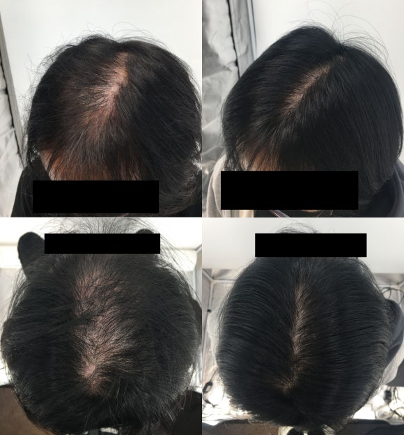 두피주사 6개월 맞고 보인 전후 모습 대공개 관련 이미지 5