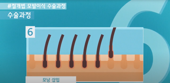 모발이식 수술 뉴헤어에서 알아보기(절개,비절개,헤어라인,모발이식방법,수술) 관련 이미지 6