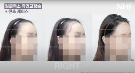 이마축소! 얼굴 작아지는 헤어라인교정 l 여자 모발이식 전후 사진 보기 관련 이미지 6