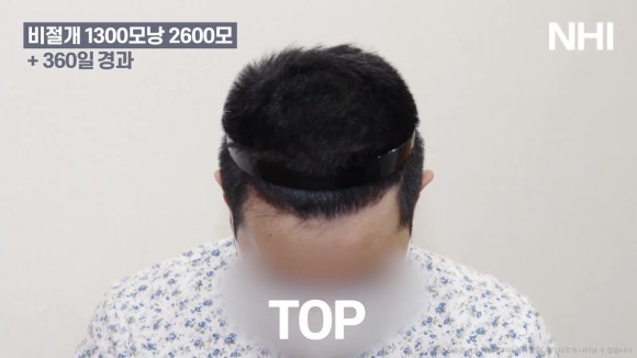 남자 앞머리 모발이식 l 탈모 모발이식 1년 전후 사진 관련 이미지 3