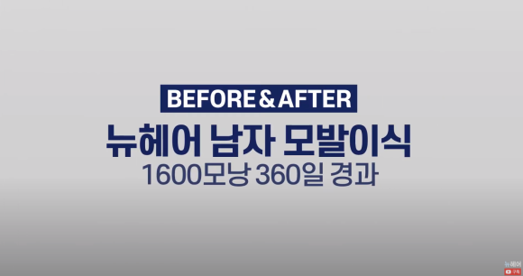 [뉴헤어] 모발이식 1600모낭 심고 1년 후 결과 l 남자 헤어라인 교정 관련 이미지 1