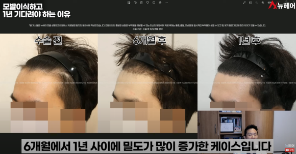 모발이식경과 1년을 기다려야 하는 이유 관련 이미지 15