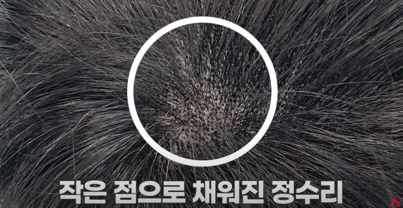 MZ세대 탈모 관리, 셀프 메디케이션? 가성비 치료방법? 관련 이미지 5