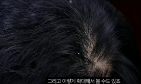 지루성 두피염 치료, 두피 환경을 바꾸는 관리법은? 관련 이미지 10