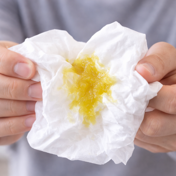 Cold That Won’t Go Away? Yellow Nasal Discharge and Postnasal Drip Symptoms: Sinusitis image 1