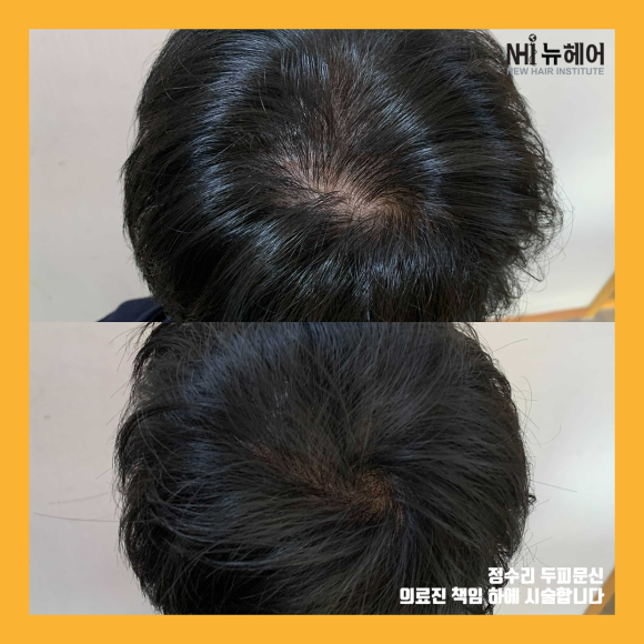 [정수리 탈모] 두피문신 전후사진 모음 관련 이미지 2