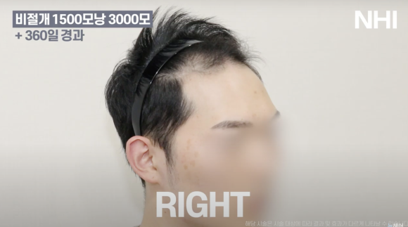 비절개 모발이식 후기 1년 사진 l 암흑기 지나고 후기 관련 이미지 3