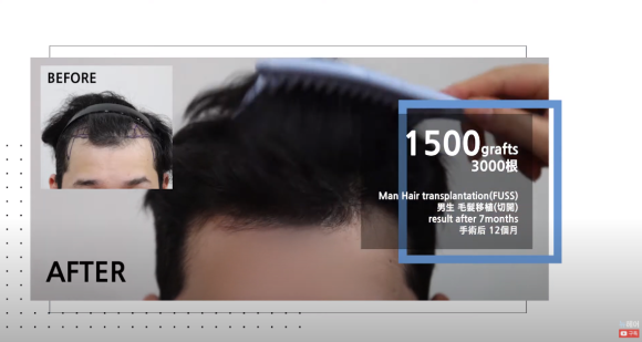 모발이식 1년 후기 빗질 영상 관련 이미지 2
