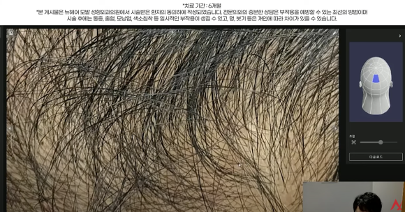 남성 정수리 탈모 치료 수술없이 주사만으로?(탈모약+주사치료) 관련 이미지 6