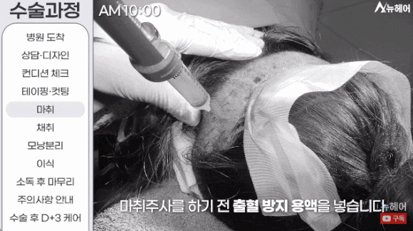 모발이식과정? A~Z 전부 공개합니다(동영상 포함) 관련 이미지 5
