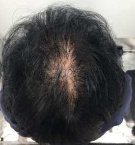 탈모모낭주사, 4달 치료받고 자신감 되찾은 50대 여성 사례 관련 이미지 5