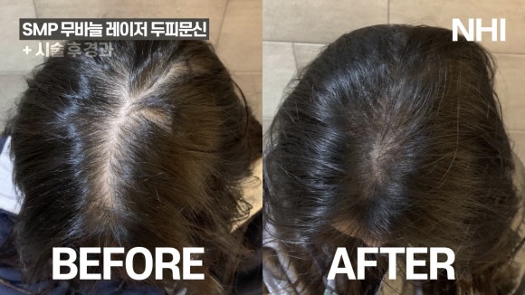정수리, 가르마 두피문신 전후 사진 모음 ㅣ 뉴헤어 관련 이미지 2