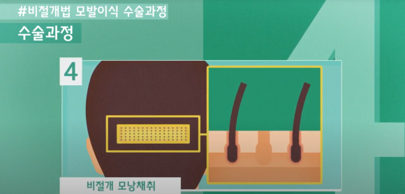 모발이식 수술 뉴헤어에서 알아보기(절개,비절개,헤어라인,모발이식방법,수술) 관련 이미지 12