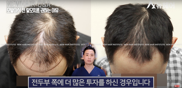 모발이식 알아봐야 한다면 관련 이미지 9