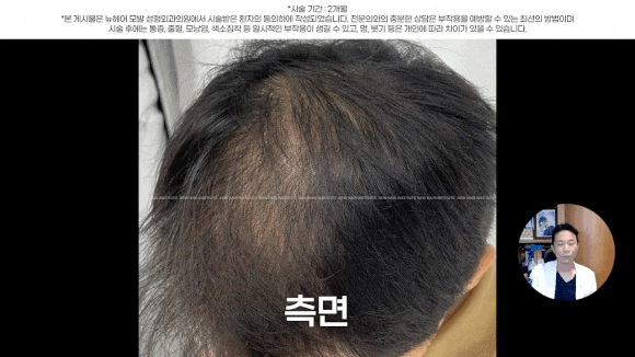 정수리탈모문신 시술직후 나타나는 효과?(전후사진) 관련 이미지 12