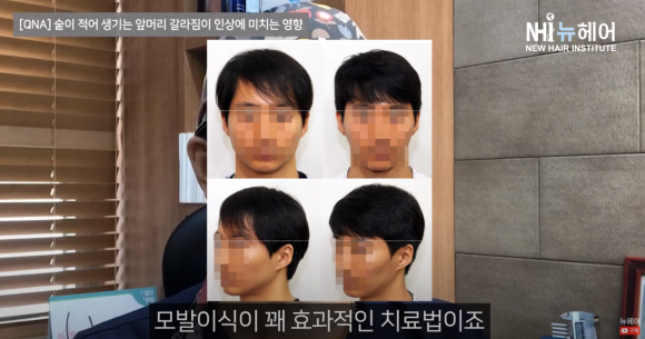 앞머리 숱이 인상에 미치는 영향 l 앞머리 갈라짐 ㅣ 탈모 관련 이미지 2