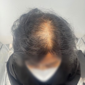 여성두피문신? 60대 실제 사례 사진으로 확인하세요 관련 이미지 11