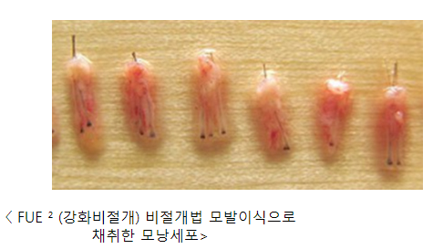 비절개 모발이식 vs 절개 모발이식 생착률 결과 차이 관련 이미지 6
