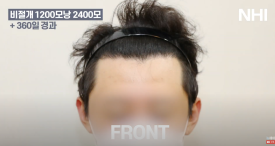 비절개 모발이식 헤어라인 엠자채우기 l 남자 탈모 모발이식 2400모 전후 사진 후기 관련 이미지 2