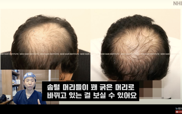 탈모치료 엑소좀, 엑소좀 뜻, 역할, 탈모 치료 효과ㅣ 정수리 탈모 ㅣ 전후사진 관련 이미지 16