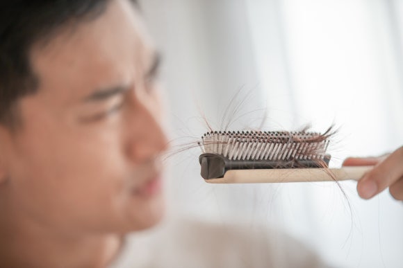 스트레스 탈모 의심된다면? 머리 빠짐과 마음 건강의 연결고리 관련 이미지 1