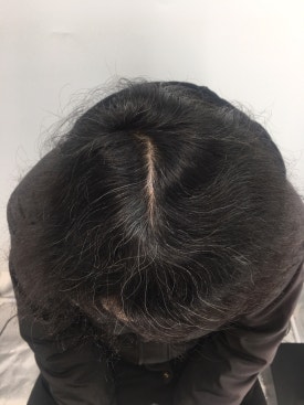 남성형 탈모 치료, 6개월 만에 이루어낸 변화 대공개 관련 이미지 4