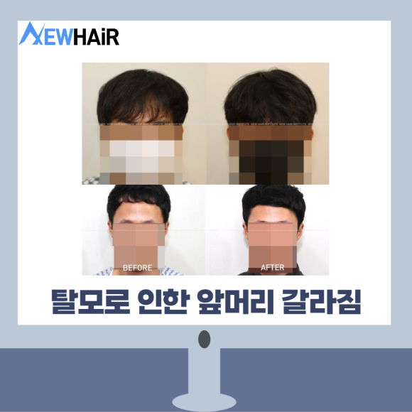 서울탈모 이식 병원 만족하는 결과를 위해 관련 이미지 2