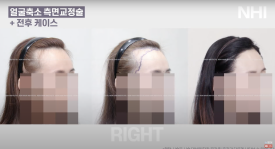 이마축소! 얼굴 작아지는 헤어라인교정 l 여자 모발이식 전후 사진 보기 관련 이미지 4