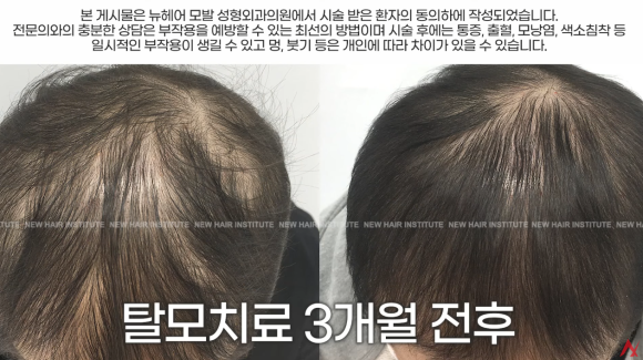 항암치료 후 탈모 극복, 이렇게 탈모치료하세요(탈모약, 영양제, 주사) 관련 이미지 1