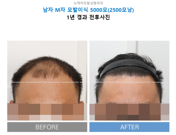 남자 탈모 vs 여자 탈모, 치료법이 다른 3가지 이유 관련 이미지 4